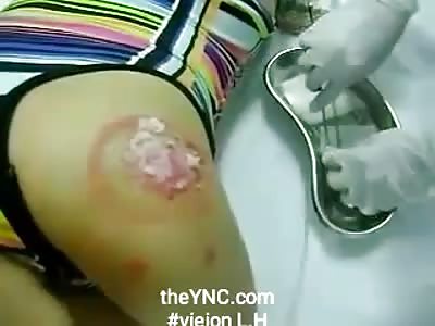 Extracting worms from girl's shoulder