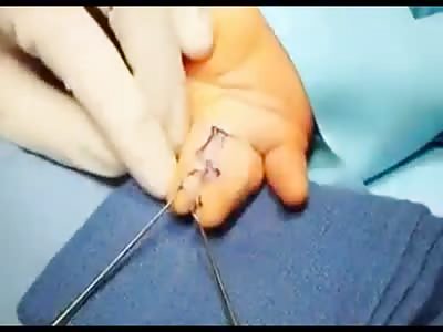Surgery to seperate fingers