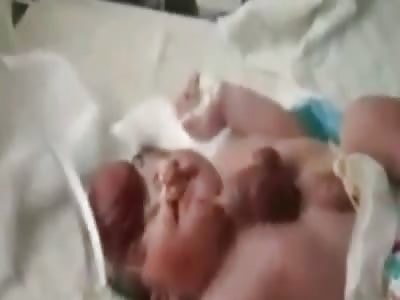 Horrible deformities in newborn baby