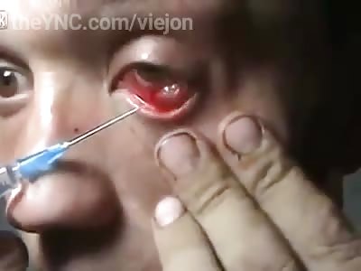 Lunatic man injected silicon into the eyes