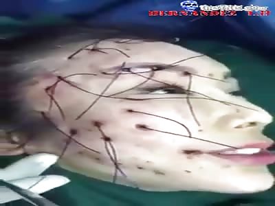Removing stitches on face