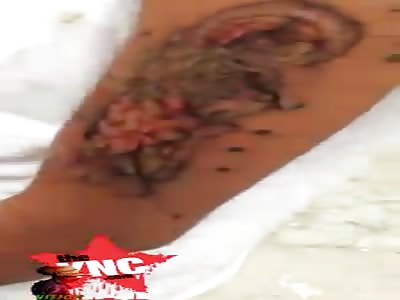 Infection in tattoo of teenager