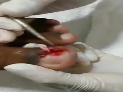 Gross - Maggots dug out of womans big toe