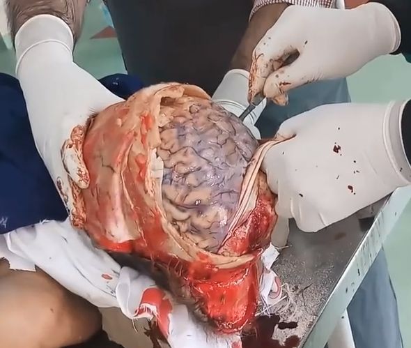Removing Brain From Dead Old Man in India