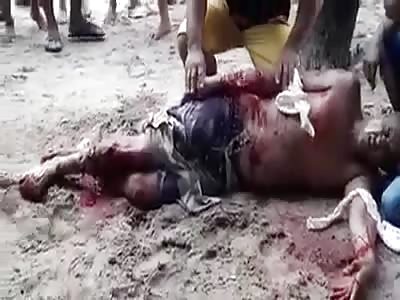 Close up of Man After Brutal Shark Attack in Recife, Brazil