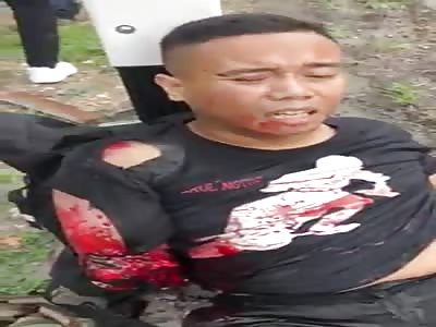 Guy loses arm and snaps foot in Indonesian accident.