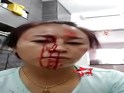 Woman shows the beating result her husband gave her