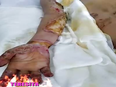Aftermath of accident, woman with burns throughout the body (pictures)