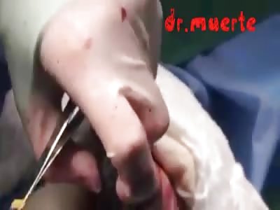 Gangrenous fingers amputation