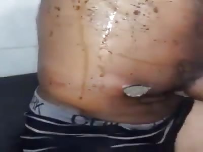 WTF Infected wounds filled with worms