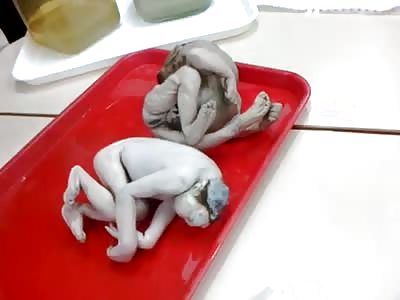 Shocking video not suitable for sensitive. Fetuses with malformations