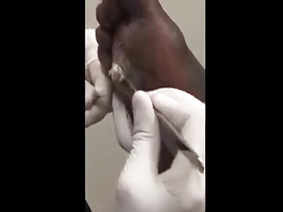 WTF removing an evil cyst should not only be painful! It is also disgusting and uncomfortable to watch!