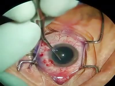 eye surgery to remove cataracts