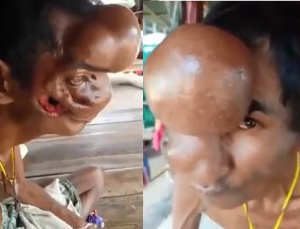 Disfigured face ... Horrific tumor 