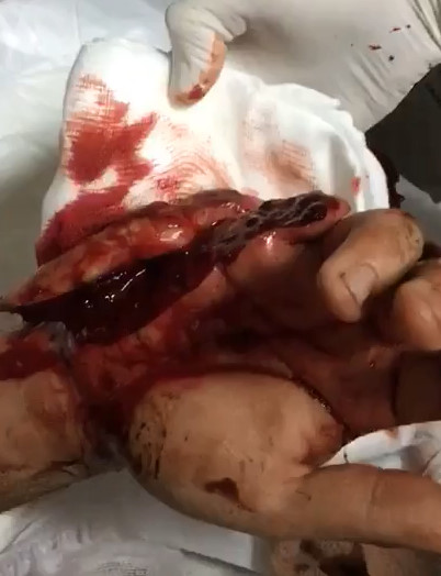 Horrible injury in the hand by machete attack