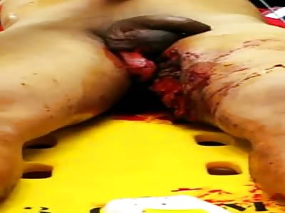 Ballsack Ripped Open in Stupid Accident [Action+Aftermath]