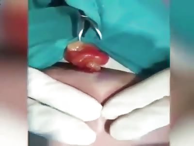 Implant infection