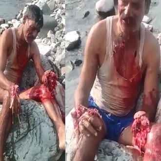 Man Left with Hands Fucked Up after Fishing with Dynamite Went Wrong
