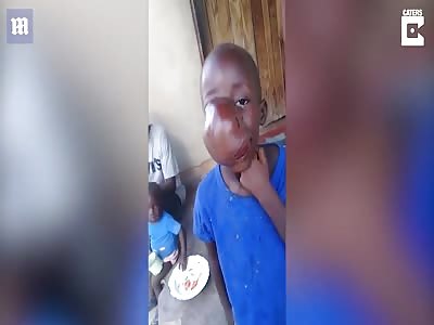 Young boy has agonising football-sized tumour on his face