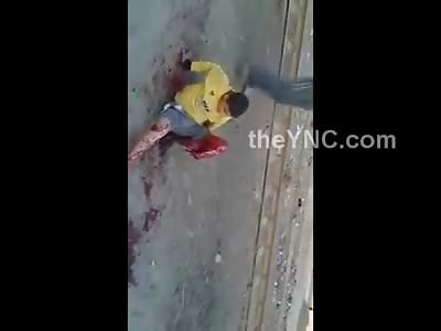 Young Kid in Yellow Shirt Has his Leg Ripped off and Skin Just Dangling ... In Total Shock