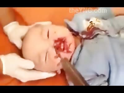 Doctors Fight to Save Baby with Butcher Knife in its Head .. Mother Stabbed Him Because he Bit her Breast