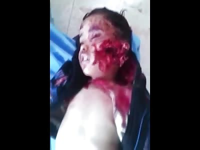 Sickening Video of Young Boy with Shrapnel to the Face from ISIS 