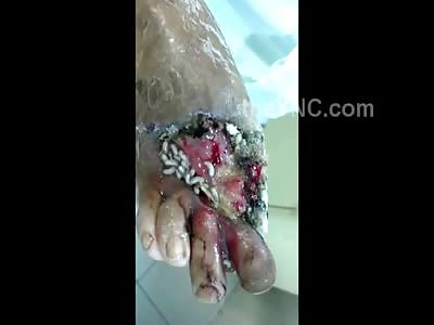 Disgusting Mangles Maggot infested Foot