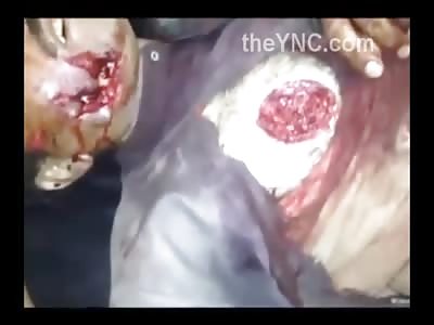Guy with Fucked up Hole in His Chest in Agony as Doctor Puts his Finger In it