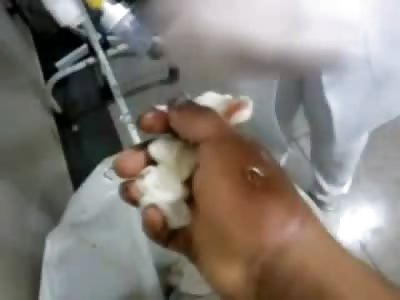 Fistful of Needles?? Very Bizarre Video shows Man with Hooks for Finger Nails 