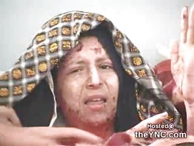 Woman burnt Horribly by her Husband in Badghis Afghanistan