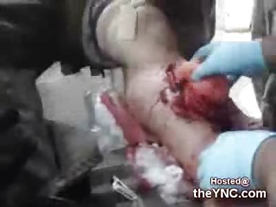 Horrific Wound from a Bullet on a Civilian in Iraq