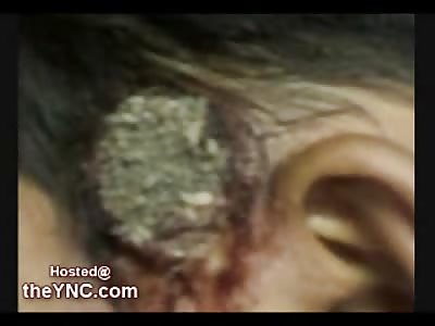 Disturbing Video shows a Boy with a Maggot Infection inside of his Head (Graphic Video)
