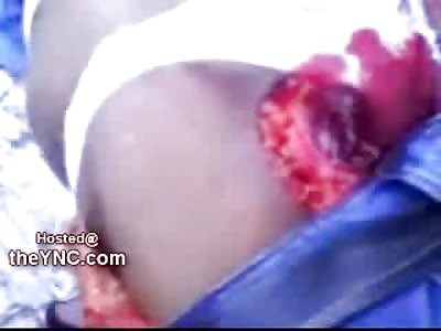 Nightmare: Man has Intestines Pushed out through his Anus and he is Alive