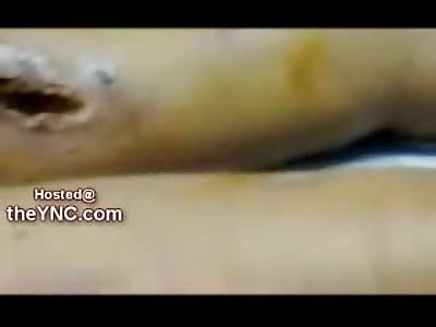 SUFFERING: Naked Female Drug Addict Dying with Rotting Legs from Drug Use (Watch Full Video)