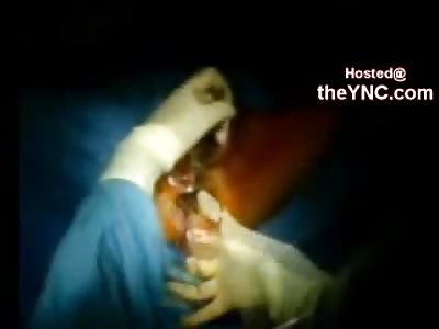 I Bet you Cant Watch All of This.....Giant Surprise Pulled out of Mans Ass in Emergency Surgery