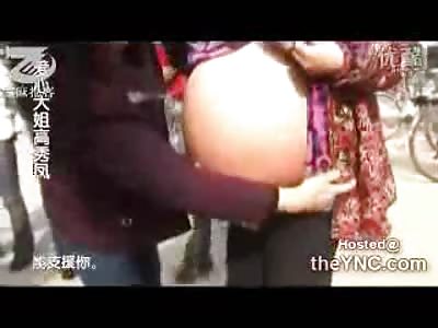 Begging Female in China has GIANT Tumor Growing in her Stomach