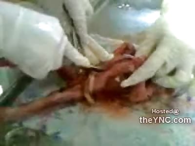Short Video of Aborted Baby Autopsy in Russia