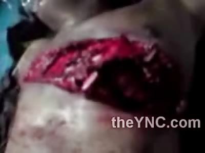 Amazing Medical Video: Pounding Heart Exposed through Rib Cage of Suffering Man