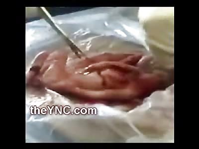 Watch FULL Video: Extremely Offensive Footage of a Very Brutal and Rough Autopsy on a Dead Baby, includes Brain Removal (Warning this Video is Graphic)
