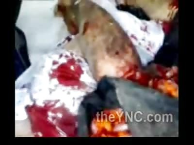 Intestines Shoved in a Bag....Man Blown up During Syrian Battle