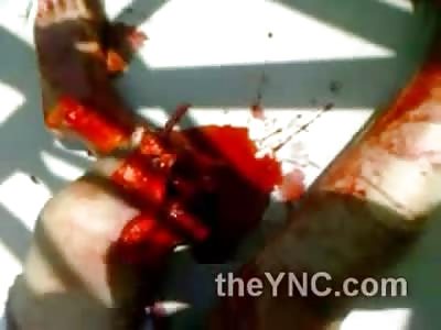 OUCH: Poor Kids Foot Severed ...In Total Shock