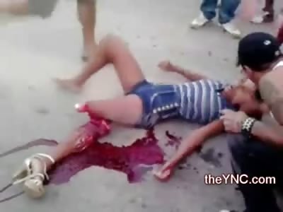 Dont try to Get Up! DIfferent Video of Girl with Horribly Severed Leg