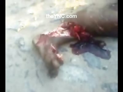 Female with with Fatty Flesh and Muscle Exposed is Loaded onto Gurney (Watch Full Video)