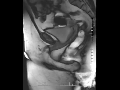 Taking a Shit as Seen through an MRI