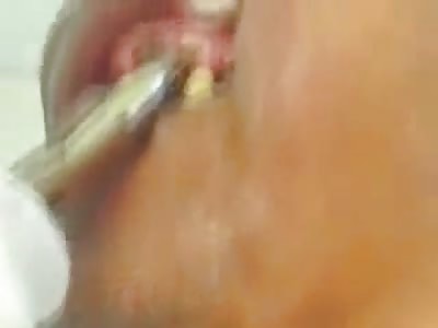 Disgusting Video of a Man with horrific Maggot Infested Toothache