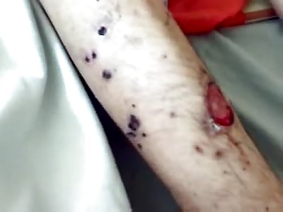 Drug Addict has Severe Scabs all over his Body