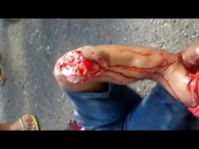 Young Boy with Gruesome Leg Trauma and Blood Flowing from the Mouth