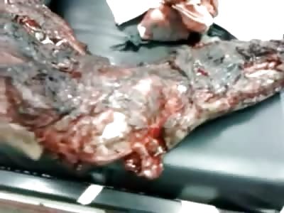 Man had Accident with a Grenade...Still Alive GRUESOME VIDEO 