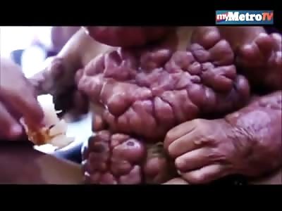 Sad Video of Boy with Bizarre Disease and intestines growing on outside of Body