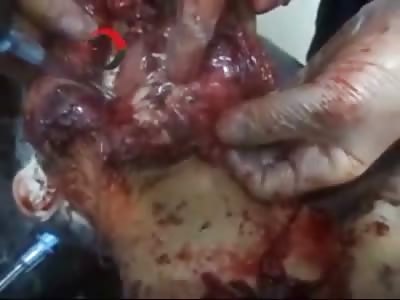 Mouth blown Open and Destroyed as Doctors try to Put it Back Together